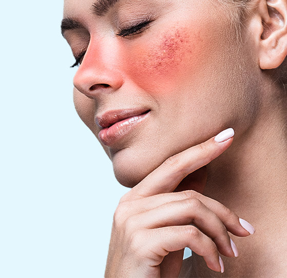 Woman with rosacea